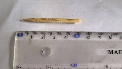 惊险！事发长沙！急刹后，竹签插进2岁男童脸部